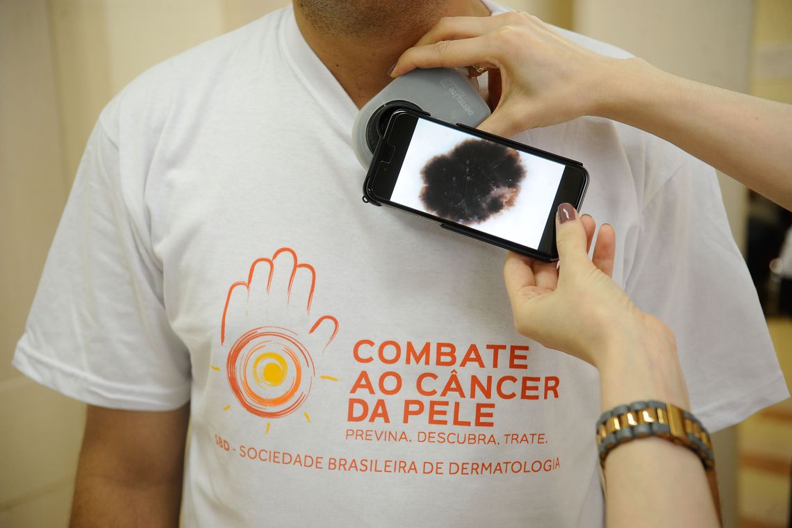 Pesquisadores desenvolvem software para diagnosticar melanoma