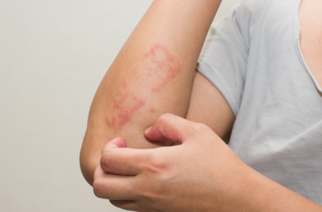 Doenças de pele: estresse e ansiedade podem causar irritações no corpo