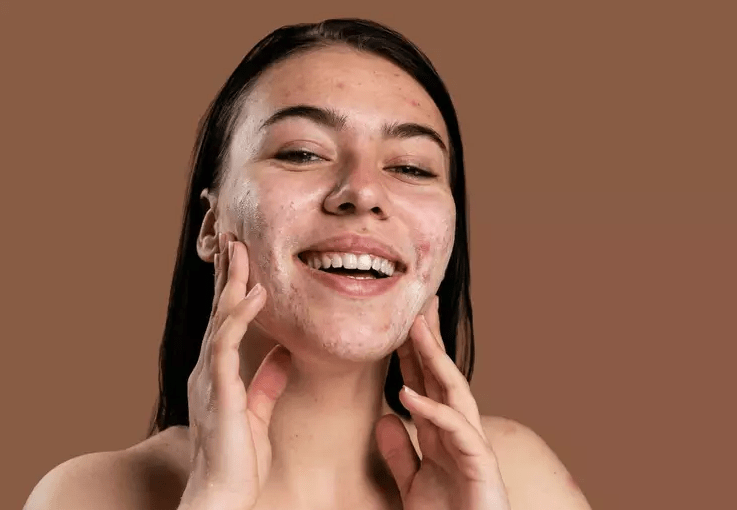 7 produtos para combater a acne e controlar a oleosidade da pele